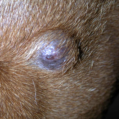 We were able to remove this epidermal cyst, a benign tumor without general anesthesia, by using a local anesthetic.